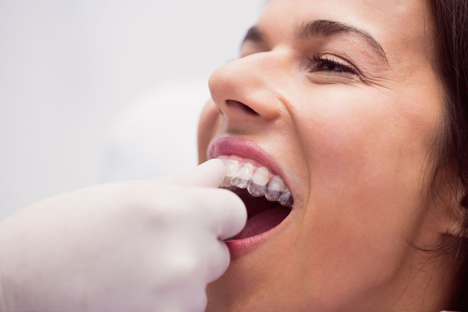 Niềng răng trong suốt Invisalign
