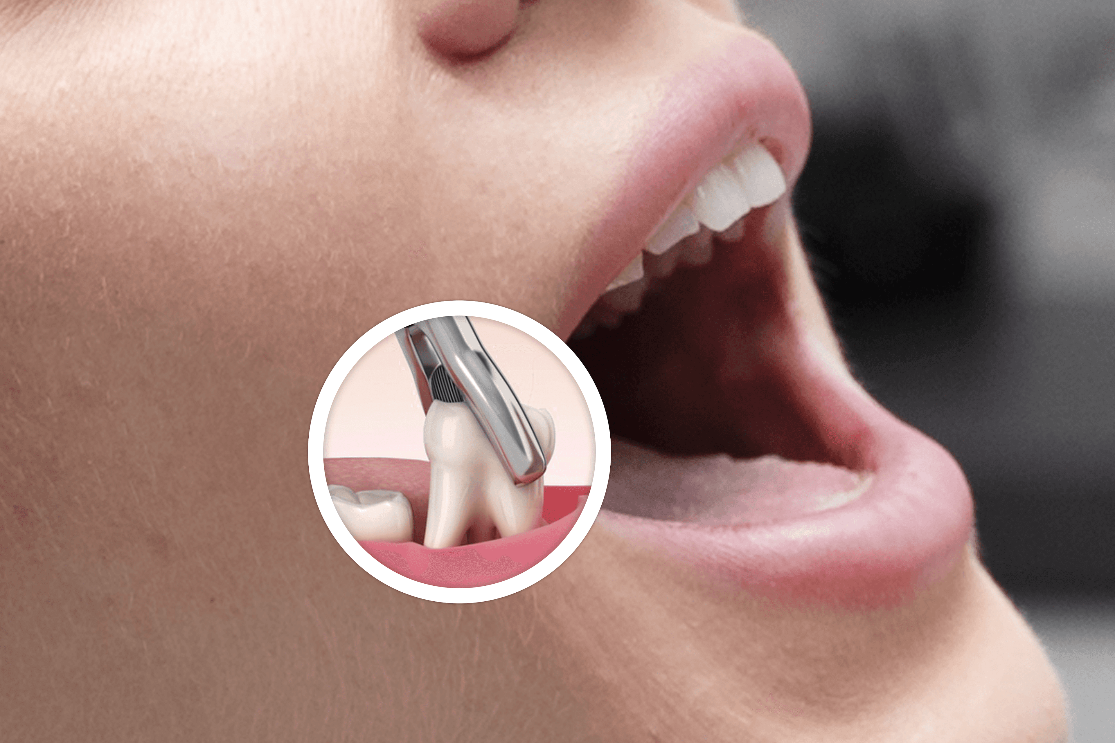 Răng sứ thẩm mỹ & veneer