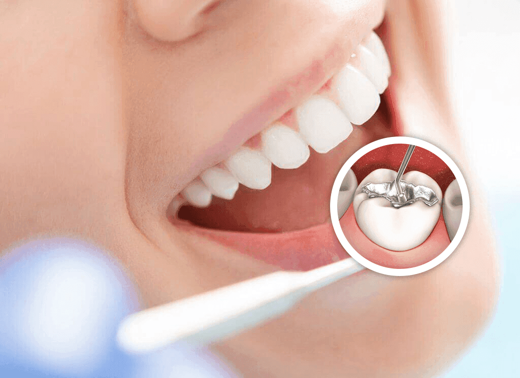 Niềng răng trong suốt Invisalign