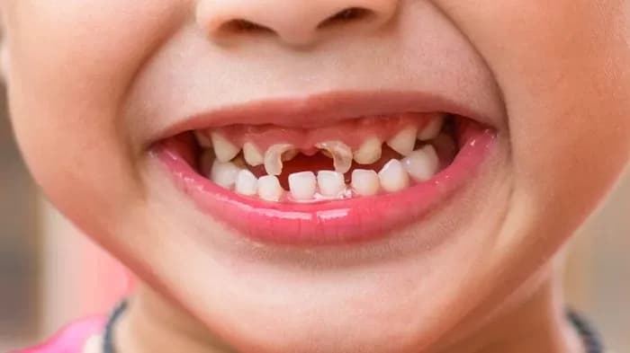 Trám răng trẻ em